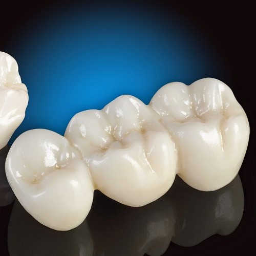RĂNG SỨ ZIRCONIA ĐỨC